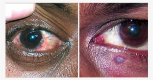 Eyes - Eye