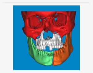 D Cad Model Of The Patient - Computer-aided Design