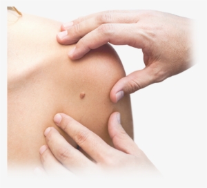 Home Page Slideshow Mole - Washington Manual Of Dermatology Diagnostics [book]