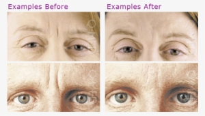 Botox New - Botox Before And After