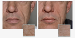 Anti Wrinkle Brisbane - Wrinkle