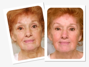 Before And After Laser Anti-wrinkle Treatment - Collage