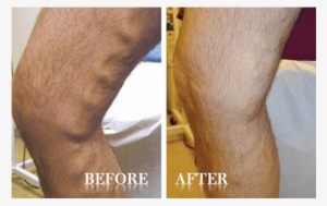 Advanced Vein & Laser Center Contents Gallery Vein - Horse Chestnut Varicose Veins Before And After