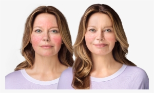 For Persistent Facial Erythema Associated With Rosacea - Before And After Ad