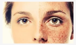 Freckles Are Skin Cells That Contain A Pigment Called - Yüzdeki Çiller Nasıl Geçer