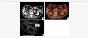 Radiological And Endoscopic Ultrasonographic Findings - Computed Tomography