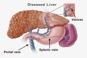 Gastroesophageal Varices Icd 10