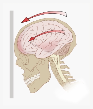Concussion - Concussion Definition