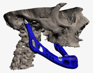 3d Printed Titanium Implant - 3d Druck In Der Medizin