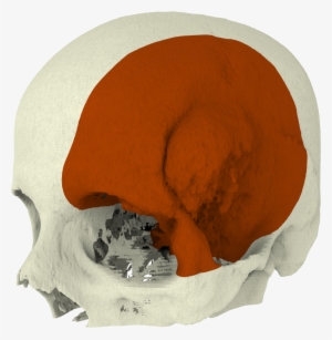 Together With The Surgeon Our Biomedical Engineers - Meningioma