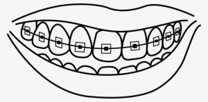 Clip Transparent Download Braces At Getdrawings Com - Teeth With Braces Drawing