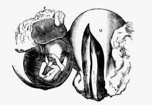 Uterus Drawing Sketch - Ectopic Pregnancy