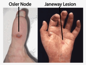 Janeway And Osler - Janeway Lesions And Osler's Nodes - 620x479 PNG ...