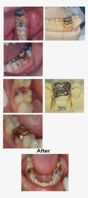 In This Case Two Gold Onlays Were Cast For The - Washington, D.c.