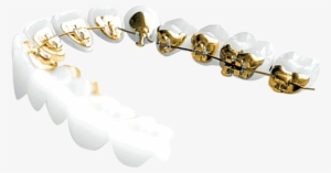 100% Customized And 100% Hidden, Incognito™ Braces - Incognito Braces Png