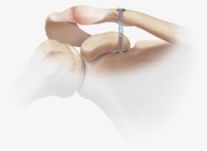 Acromioclavicular Joint Separation 1 Large - Dog Bone Arthrex