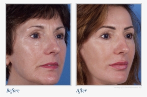 Now Available To The General Public - Skin Texture Before And After