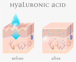Illustration Of Before And After-effects Of Hyaluronic - Injectable Filler
