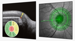 Glaucoma Module Premium Edition - Glaucoma