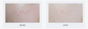 Trian Ampule - Ampoule