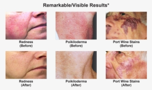*these Results Were Obtained After Multiple Treatments - Vbeam Laser