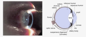 קטרקט - Human Eye