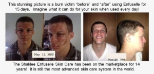 Shaklee Enfuselle - “ - Burn Skin Care Before And After