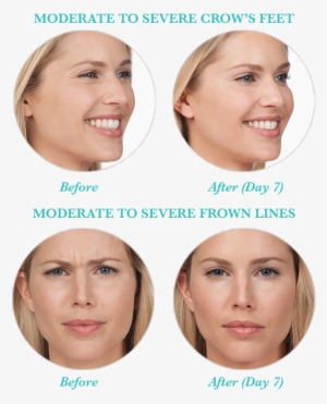In Some Cases, Botox® Can Also Be Used To Reduce Or - Botox Smile Lines
