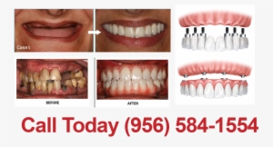 New Smile In 1 Day - New Smile Dental