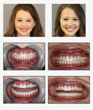 Move The Arrows On Each Image To The Left, To View - Throat