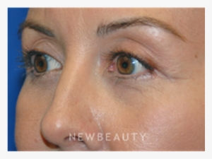 Dr Martin Otoole Blepharoplasty B - Blepharoplasty