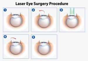 Laser Eye Surgery Procedure