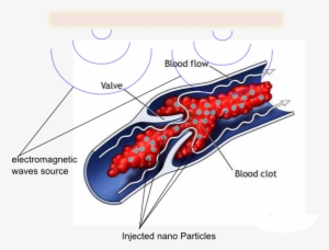 Removing Blood Clots Using Nano-particles - Blood Clot