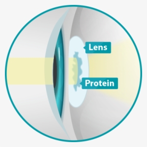 Cataracts Occur When The Lens In Your Eye Becomes Cloudy - Colorado