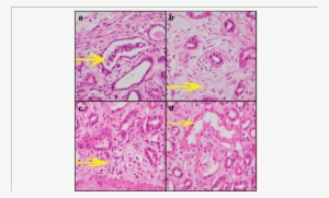 Yellow Arrow Depicts As Follows - Tubule