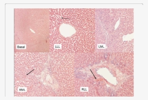 Histological Damage In Biopsy Specimens Taken After - Circle