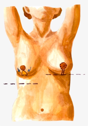 Vertical Incision Breast Reduction Scheme - Sv Plastinės Chirurgijos Centras