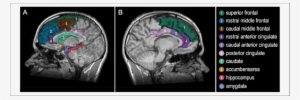 3-d Model Of The Human Brain Superimposed On The Mri - Human Brain