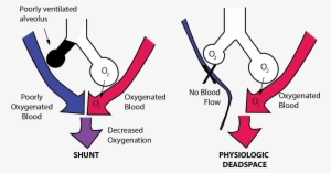 Ventilation Perfusion Mismatch - Pulmonary Shunt