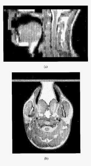 Method Of Terminating The Open Mouth To Contain The - Radiology