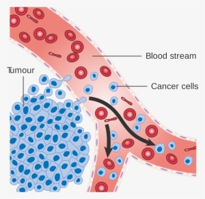 Diagram Showing Cancer Cells Spreading Into The Blood - Cancer Cells Spreading Through Body