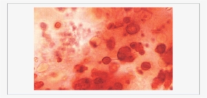A Synovial Fluid Wet Smear Stained With Alizarin Red - Synovial Fluid Alizarin Red