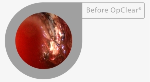 Opclear® Removes Blood - Spiral Galaxy