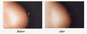 Nipple Reduction - Nipple Injections Before And After