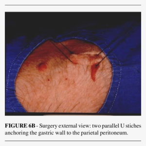 A-schematic Gastric View - Oftalmopatia Tiroidea