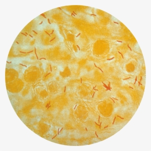 Tb In Sputum - Mycobacterium Tuberculosis