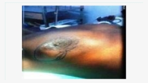 Upper Outer Tumour Breast - Neoplasm