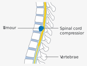 Define Spinal Cord Compression