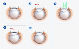 The Doctors At New Orleans Eye Specialists Have Performed - Laser Eye Surgery Procedure