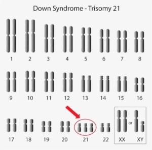 Graphic Transparent Stock Jamie Chance Trinity Tolbert - Sindrome De Patau Cromosomas